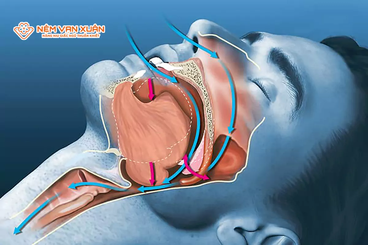 Ngưng thở khi ngủ và bệnh tim mạch